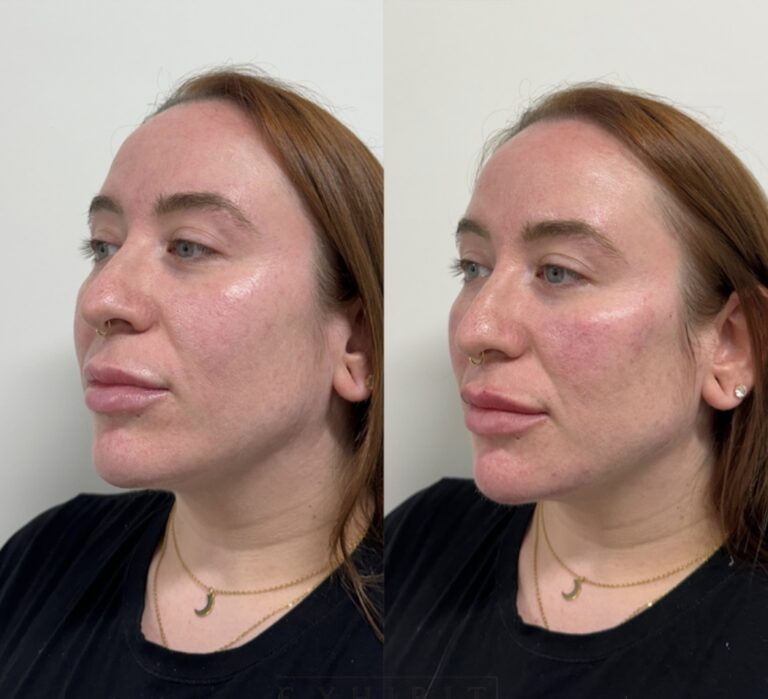 Before and after of a woman from a side profile option 1